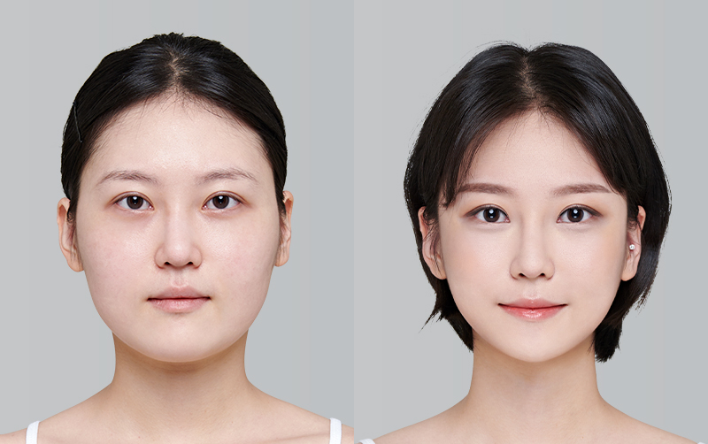 전후사진