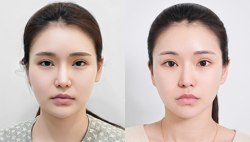 전후사진