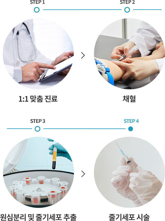 줄기세포 시술방법